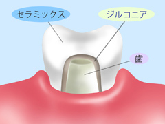 ジルコニアセラミック（詰め物・被せ物）自費診療