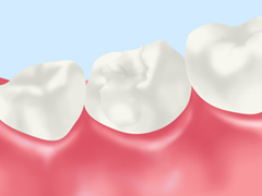 オールセラミック（詰め物・被せ物）自費診療
