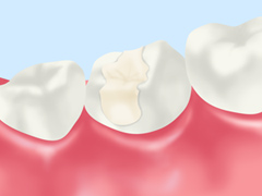 ハイブリッドセラミック（詰め物・被せ物）一部保険適用可