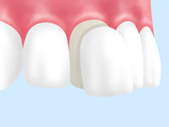 ラミネートベニア（被せ物）自費診療