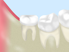 親知らずが痛んだことがある方へ