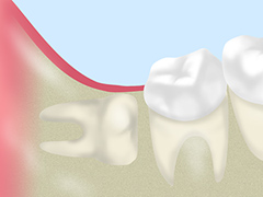 難しい親知らずの症例について